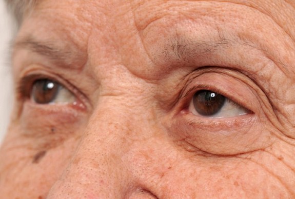 پیش بینی ابتلا به آلزایمر از روی چشم‌ها