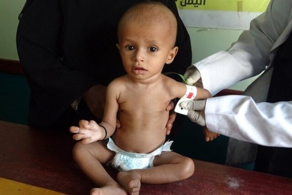 سازمان بهداشت جهانی: سه چهارم کودکان یمن از سوء تغذیه مزمن رنج می‌برند