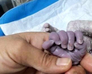 تولد نوزاد دختری با شش انگشت در پاها و و دست ها