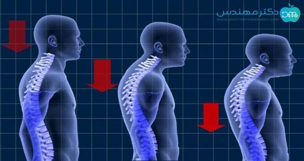 رفع قوز کمر در یک هفته با تیم دکتر مهندس