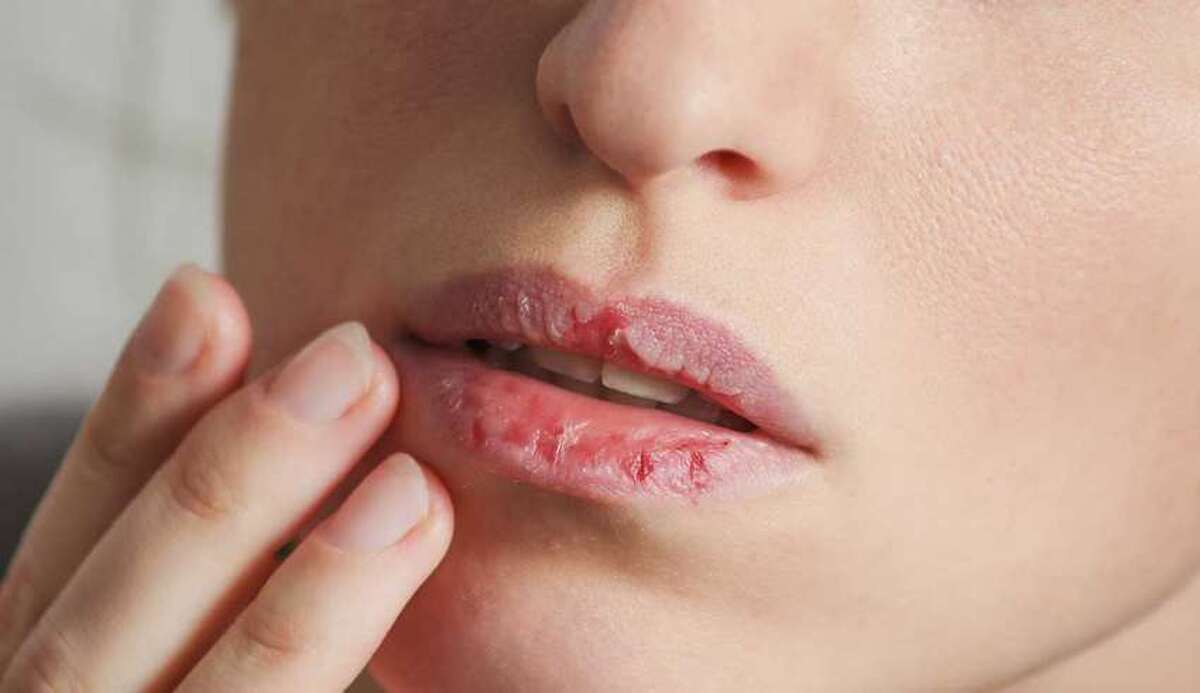 دلیل ترک خوردن لب‌ها چیست؟