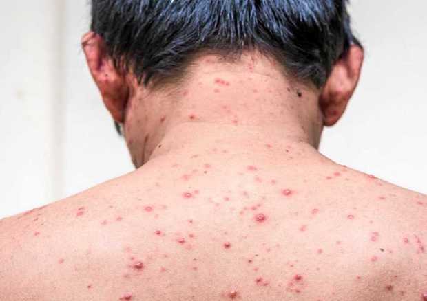 بزرگتر‌ها بیشترمراقب آبله مراغان باشند