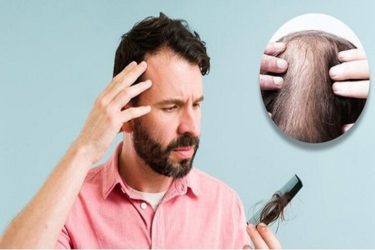 ‌می‌دانید چرا مو‌های تان به شکل سکه‌ای می‌ریزد؟