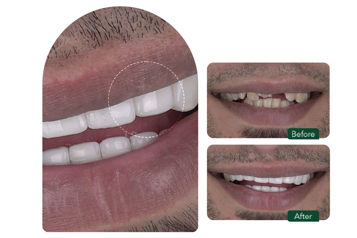 ایمپلنت یک روزه در مشهد چیست وبرای چه کسانی مناسب است؟