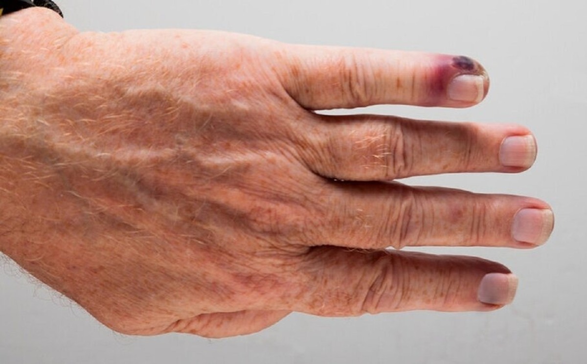 افزایش نگرانی‌ها درباره سپسیس در سالمندان؛ هشدار پزشکان نسبت به تشخیص دیرهنگام