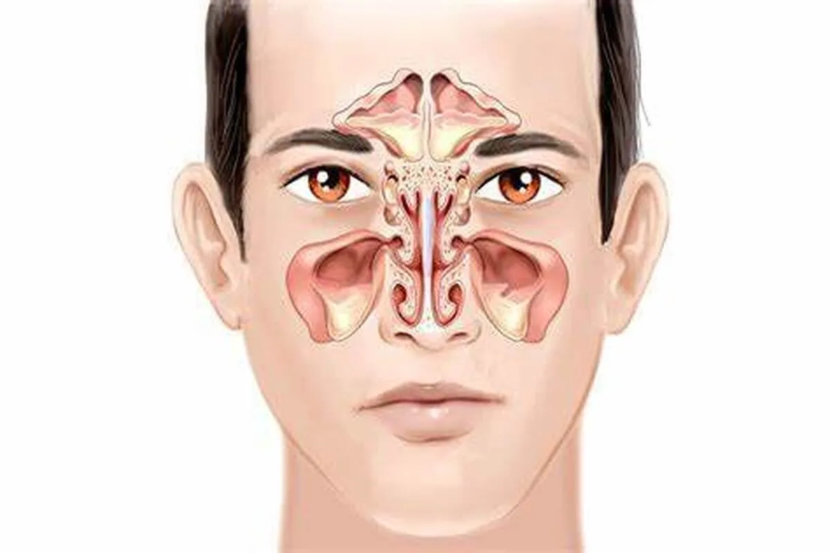 آنچه که باید درباره سینوزیت بدانید