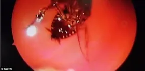 لحظه عجیب خارج کردن یک سوسک زنده از داخل جمجه یک زن + فیلم