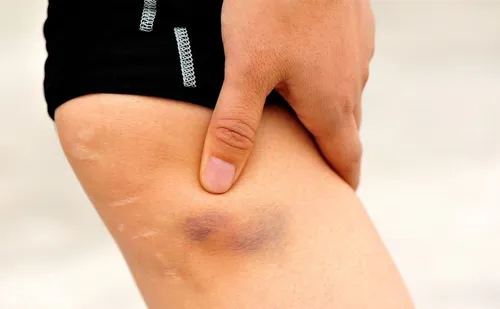 چرا کبودی بدنم خوب نمی شود؟