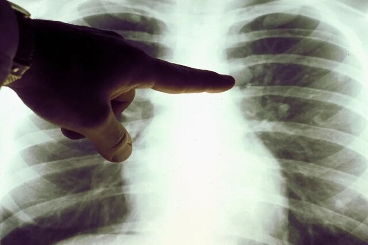 افزایش مبتلایان به سرطان ریه در غیرسیگاری‌ها در جهان